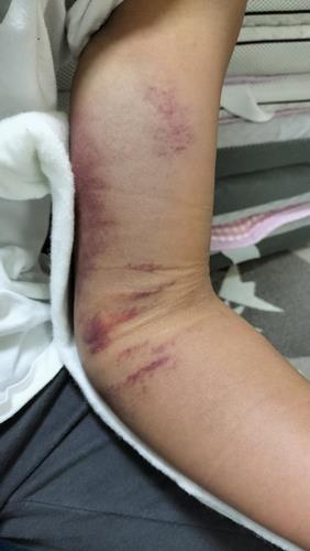 怪我した腕の状態