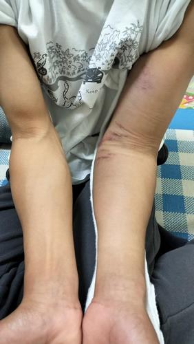腕の晴れ具合の比較